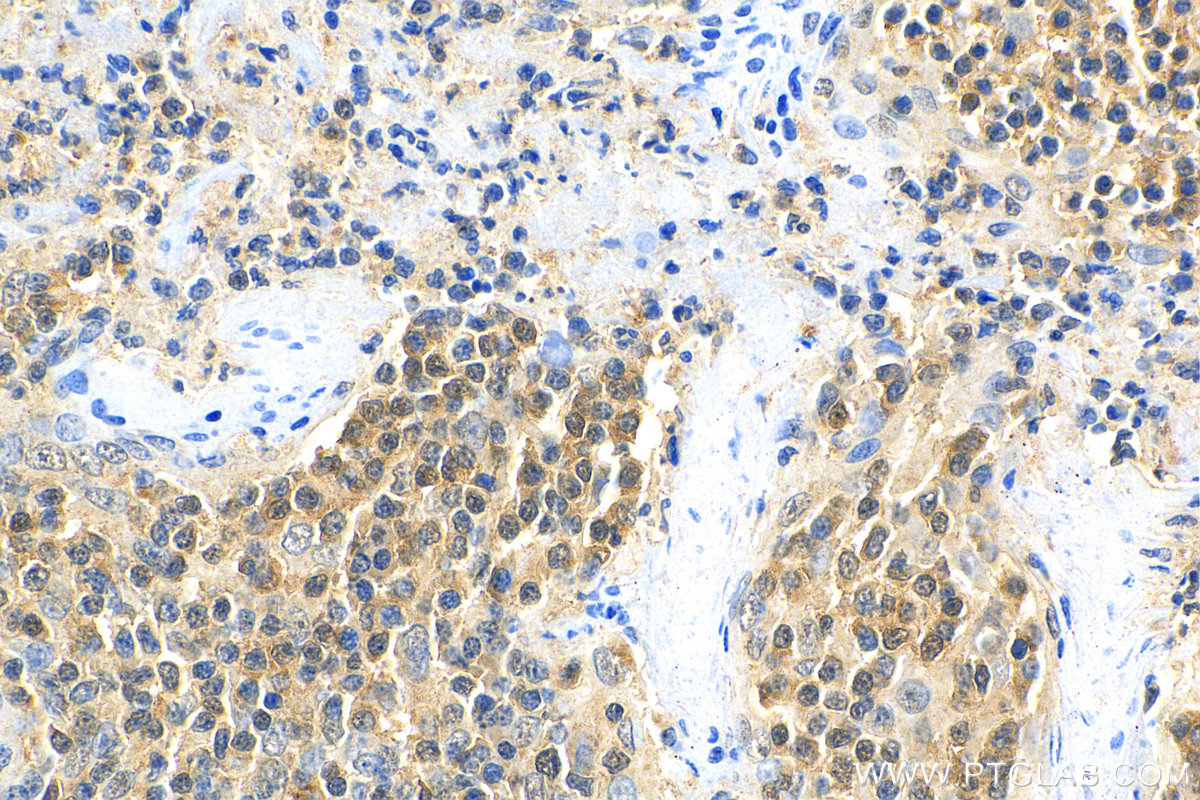 IHC staining of human tonsillitis using 11613-1-AP