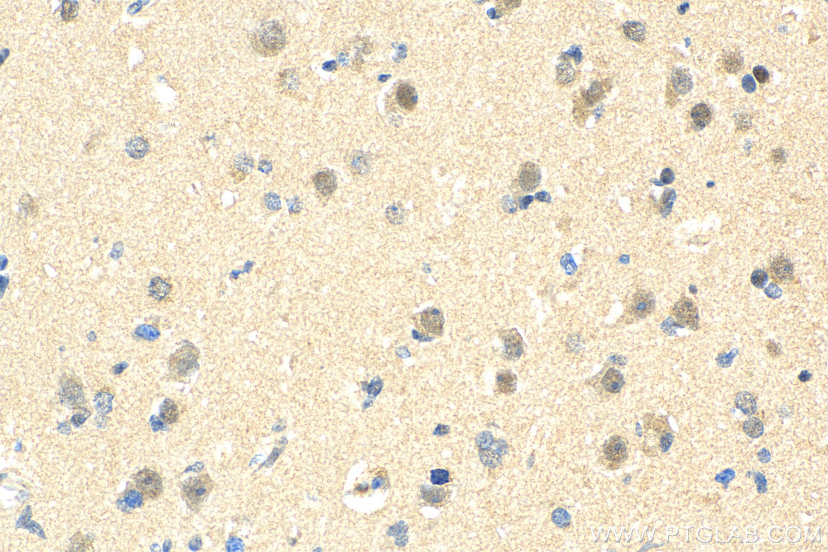 IHC staining of human gliomas using 11613-1-AP