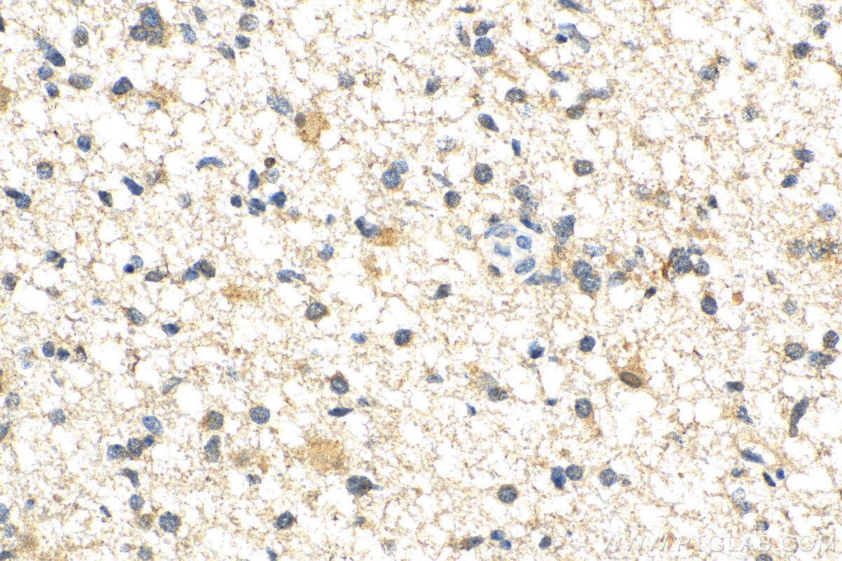 IHC staining of human gliomas using 11613-1-AP