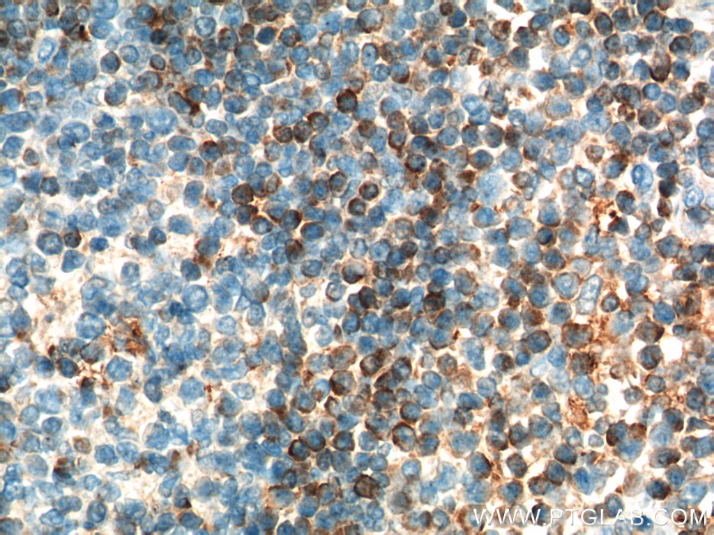 IHC staining of human tonsillitis using 12789-1-AP