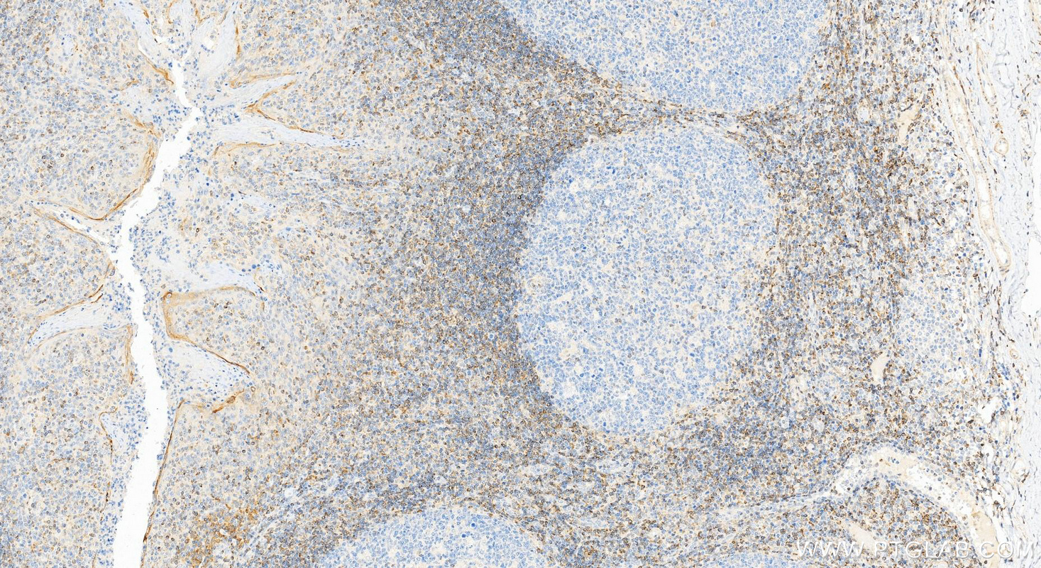 Immunohistochemical analysis of paraffin-embedded human tonsillitis tissue slide using 12789-1-AP (human BCL2 antibody) at dilution of 1:4000 (under 20x lens). Heat mediated antigen retrieval with Tris-EDTA buffer (pH 9.0). IHC staining of human tonsillitis using 12789-1-AP