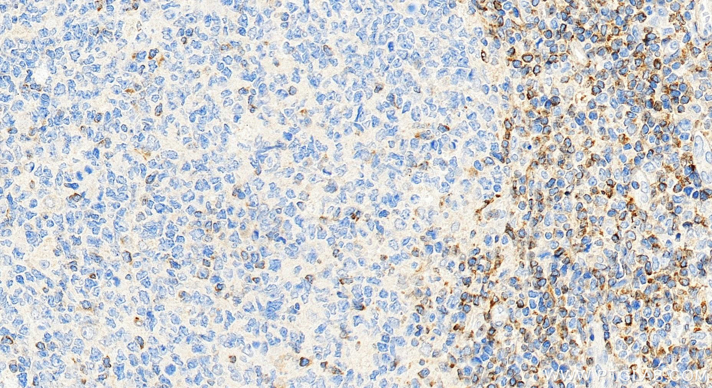 Immunohistochemical analysis of paraffin-embedded human tonsillitis tissue slide using 12789-1-AP (human BCL2 antibody) at dilution of 1:4000 (under 20x lens). Heat mediated antigen retrieval with Tris-EDTA buffer (pH 9.0). IHC staining of human tonsillitis using 12789-1-AP
