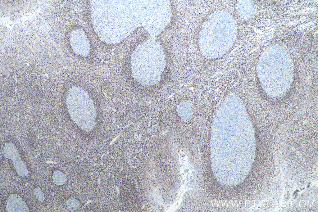 IHC staining of human tonsillitis using 60178-1-Ig IHC staining of human tonsillitis using 60178-1-Ig