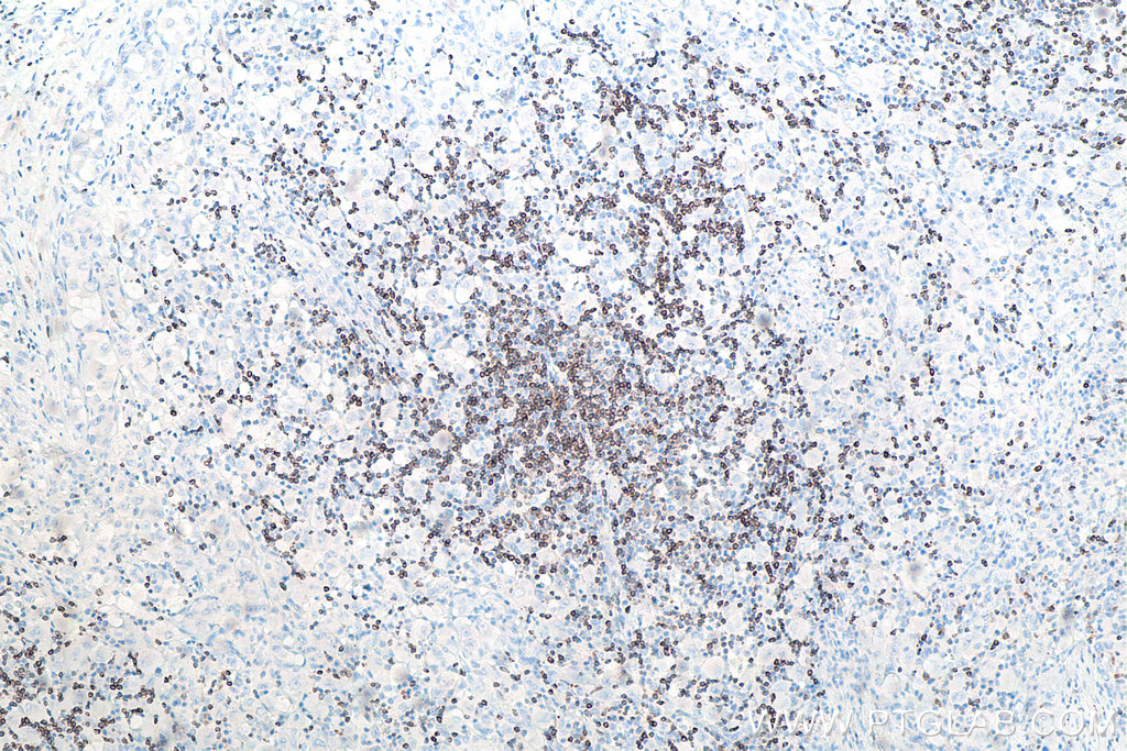 IHC staining of human lymphoma using 60178-1-Ig IHC staining of human lymphoma using 60178-1-Ig