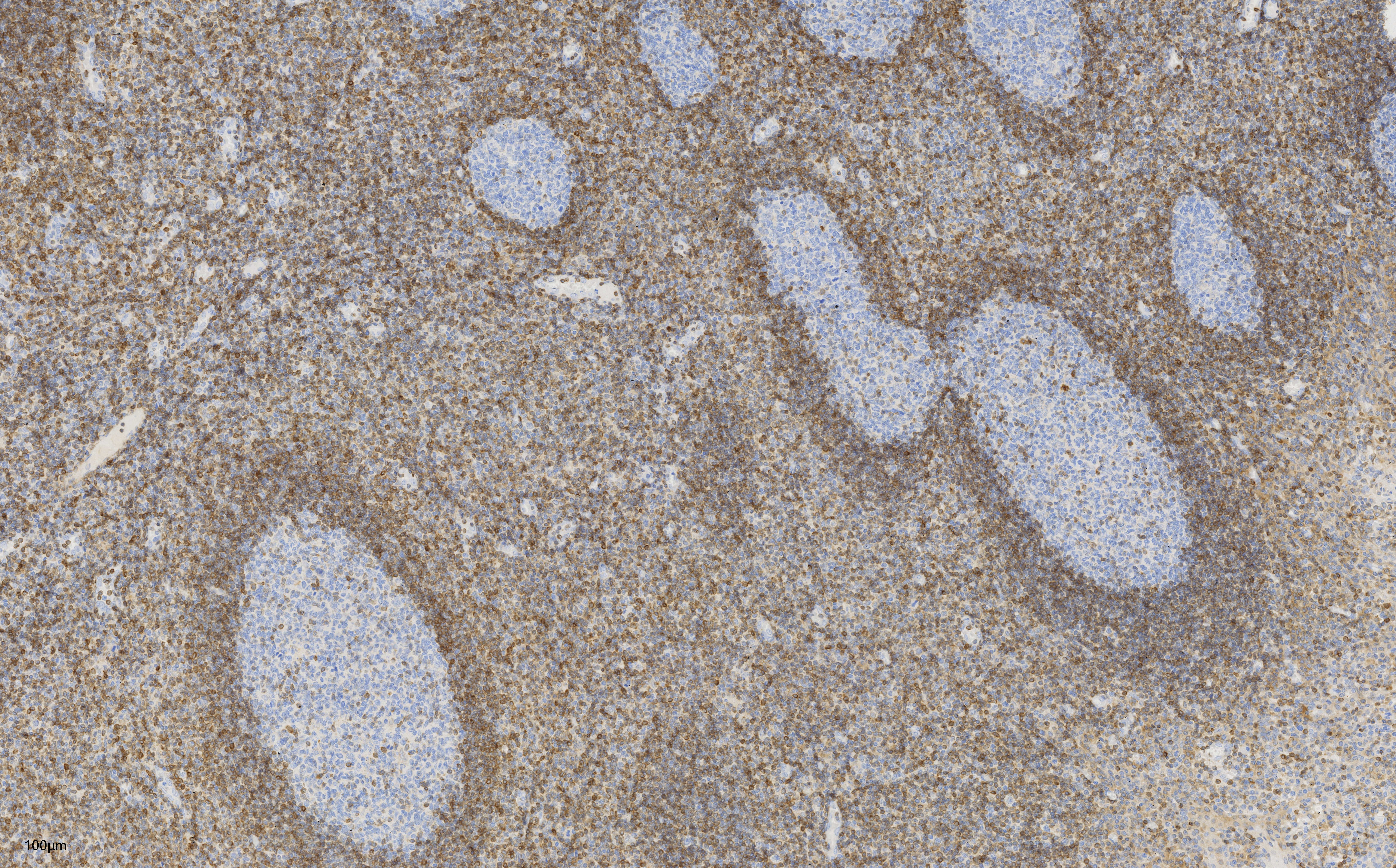 IHC staining of human tonsillitis using 60178-1-Ig IHC staining of human tonsillitis using 60178-1-Ig