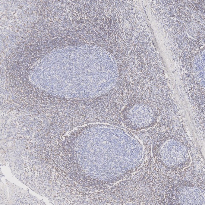 IHC staining of human tonsillitis using 60178-1-Ig IHC staining of human tonsillitis using 60178-1-Ig
