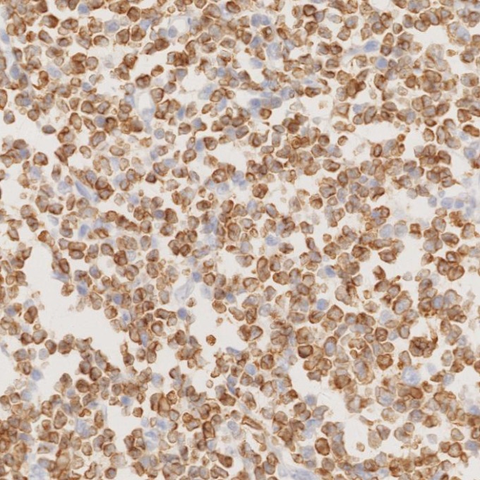 IHC staining of human lymphoma using 60178-1-Ig IHC staining of human lymphoma using 60178-1-Ig