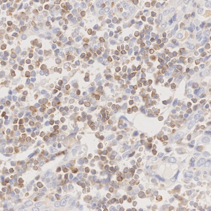 IHC staining of human lymphoma using 60178-1-Ig IHC staining of human lymphoma using 60178-1-Ig
