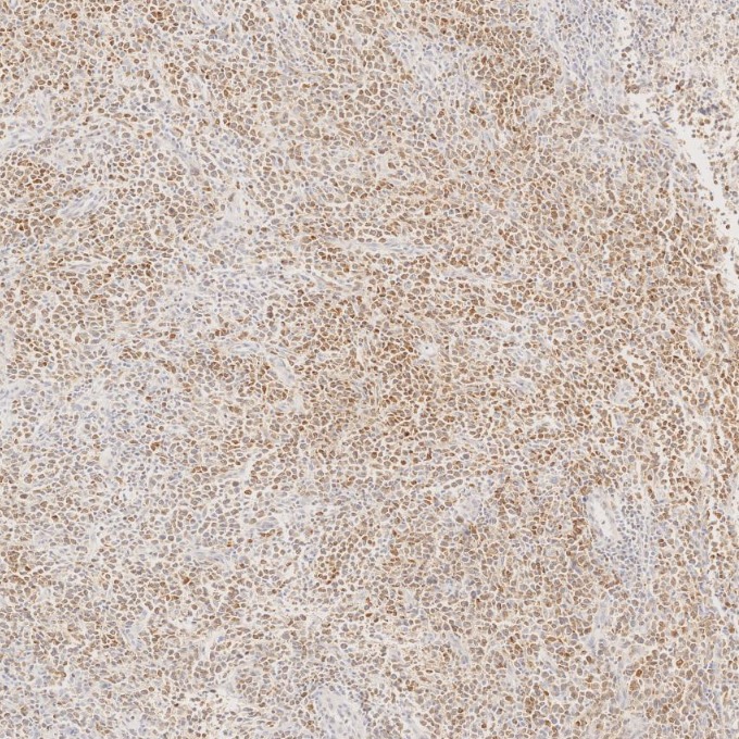 IHC staining of human lymphoma using 60178-1-Ig IHC staining of human lymphoma using 60178-1-Ig