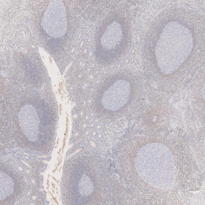 IHC staining of human appendicitis using 60178-1-Ig IHC staining of human appendicitis using 60178-1-Ig