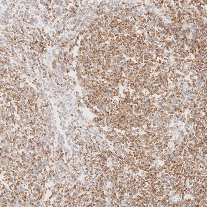 IHC staining of human lymphoma using 60178-1-Ig IHC staining of human lymphoma using 60178-1-Ig