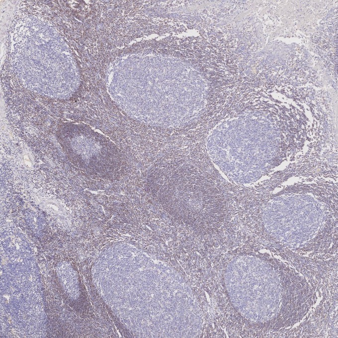 IHC staining of human tonsillitis using 60178-1-Ig IHC staining of human tonsillitis using 60178-1-Ig