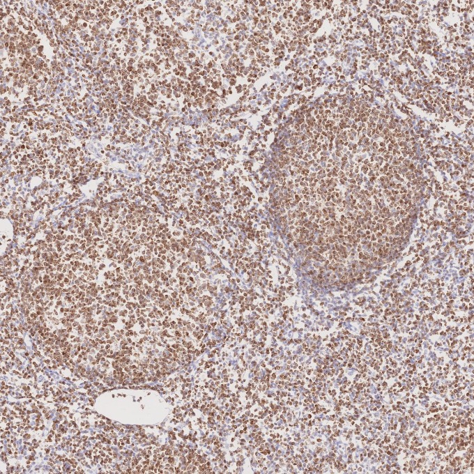 IHC staining of human lymphoma using 60178-1-Ig IHC staining of human lymphoma using 60178-1-Ig