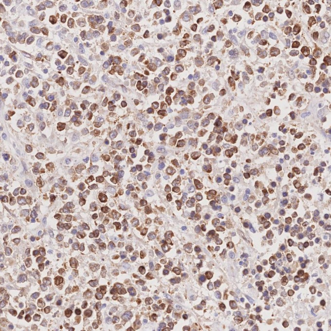 IHC staining of human lymphoma using 60178-1-Ig IHC staining of human lymphoma using 60178-1-Ig