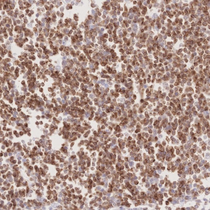 IHC staining of human lymphoma using 60178-1-Ig IHC staining of human lymphoma using 60178-1-Ig