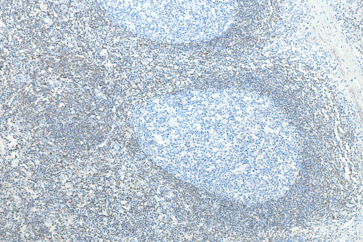 IHC staining of human tonsillitis using 80313-1-RR (same clone as 80313-1-PBS)