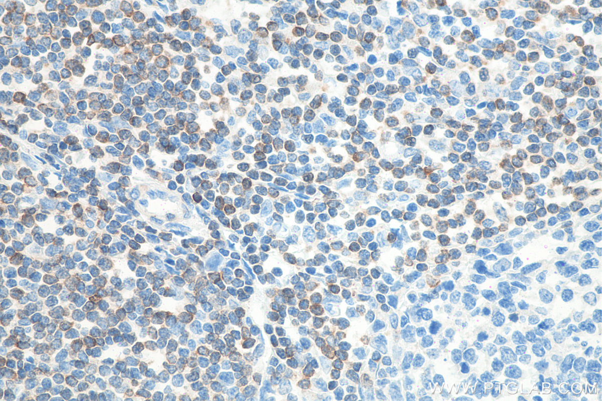 IHC staining of human tonsillitis using 80313-1-RR