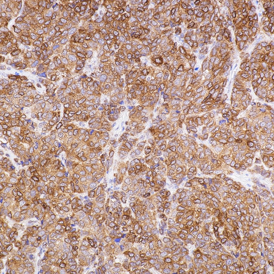 IHC staining of human breast cancer using 80313-1-RR (same clone as 80313-1-PBS)