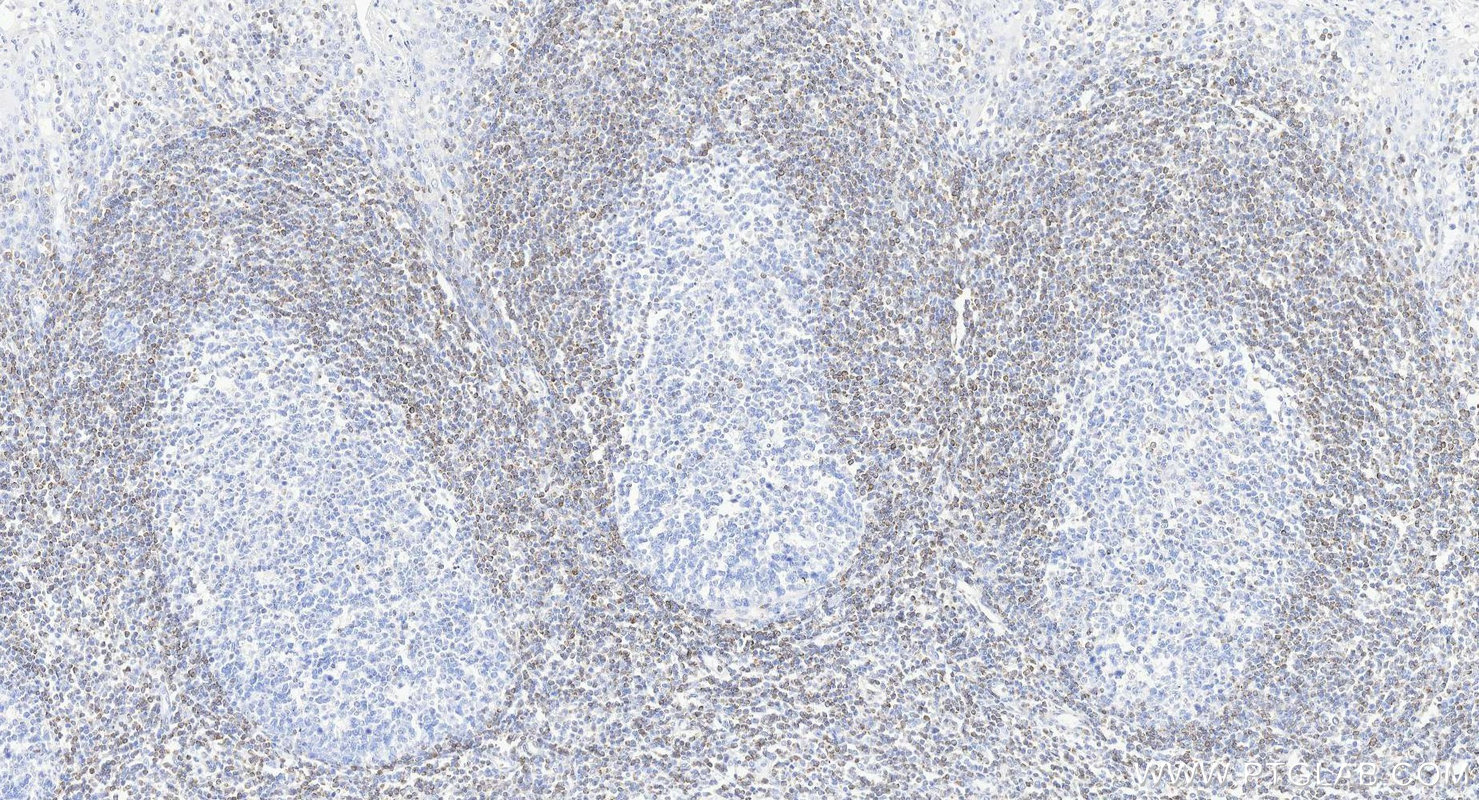 IHC staining of human tonsillitis using 80313-1-RR IHC staining of human tonsillitis using 80313-1-RR