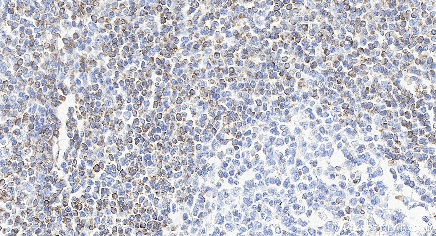 IHC staining of human tonsillitis using 80313-1-RR IHC staining of human tonsillitis using 80313-1-RR