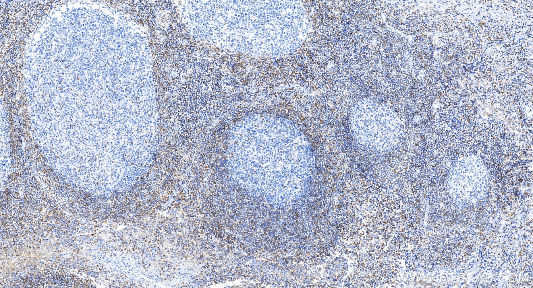 IHC staining of human tonsillitis using 80313-1-RR (same clone as 80313-1-PBS)