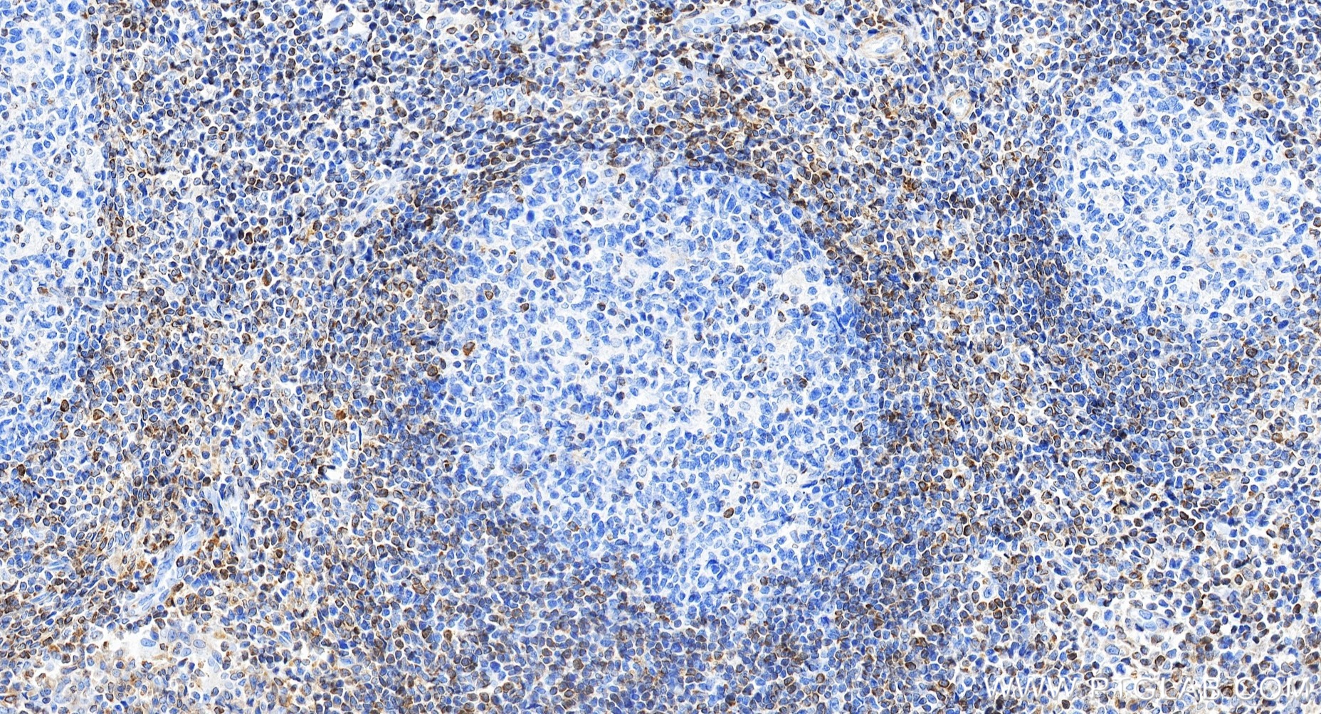 IHC staining of human tonsillitis using 80313-1-RR (same clone as 80313-1-PBS)