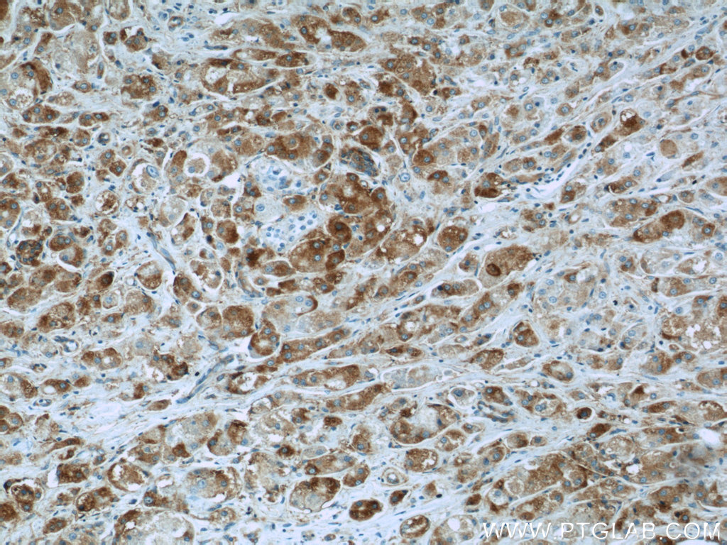 IHC staining of human breast cancer using 21969-1-AP