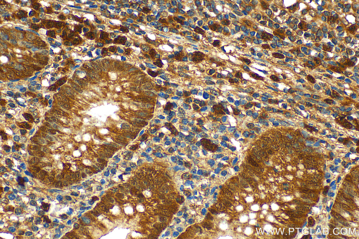 IHC staining of human appendicitis using 23975-1-AP