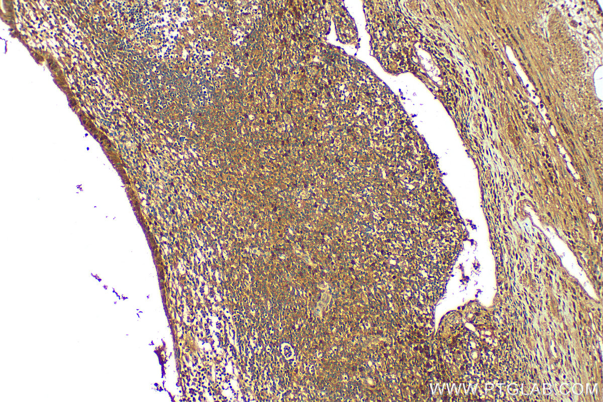 IHC staining of human appendicitis using 23975-1-AP