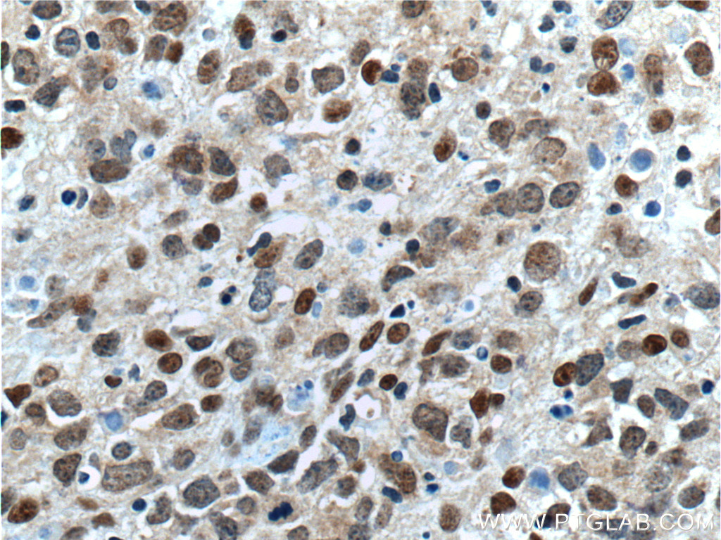 IHC staining of human lymphoma using 23959-1-AP