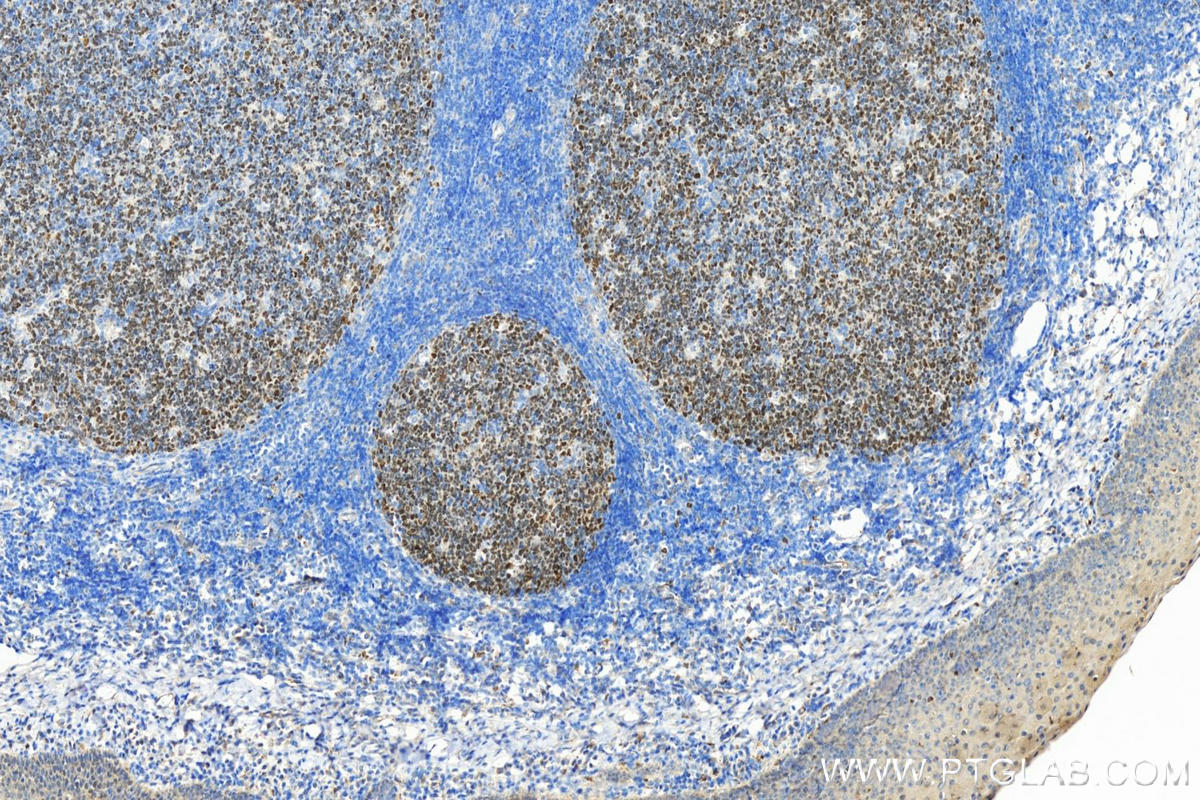 IHC staining of human tonsillitis using 21187-1-AP