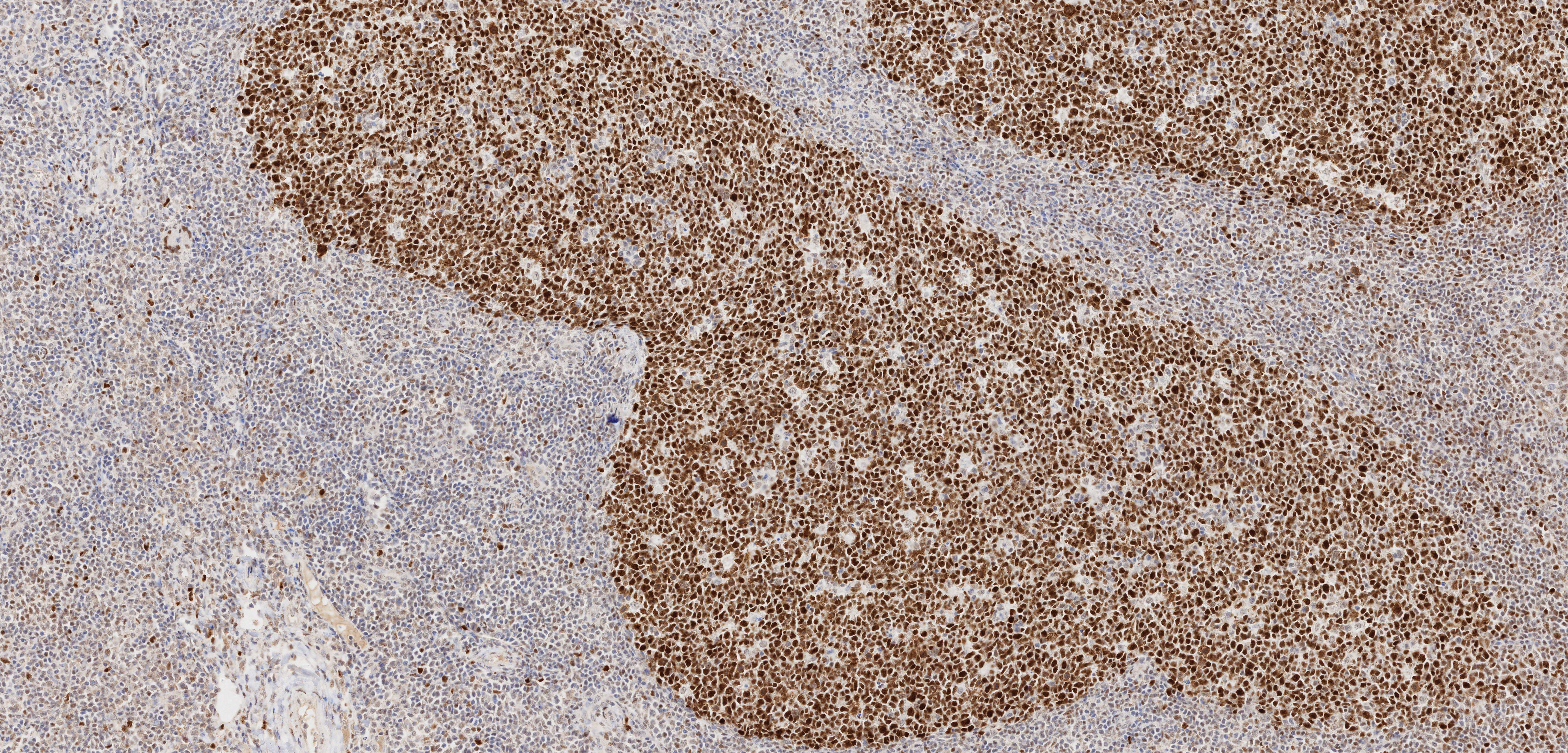 IHC staining of human tonsillitis using 66340-1-Ig (same clone as 66340-1-PBS)