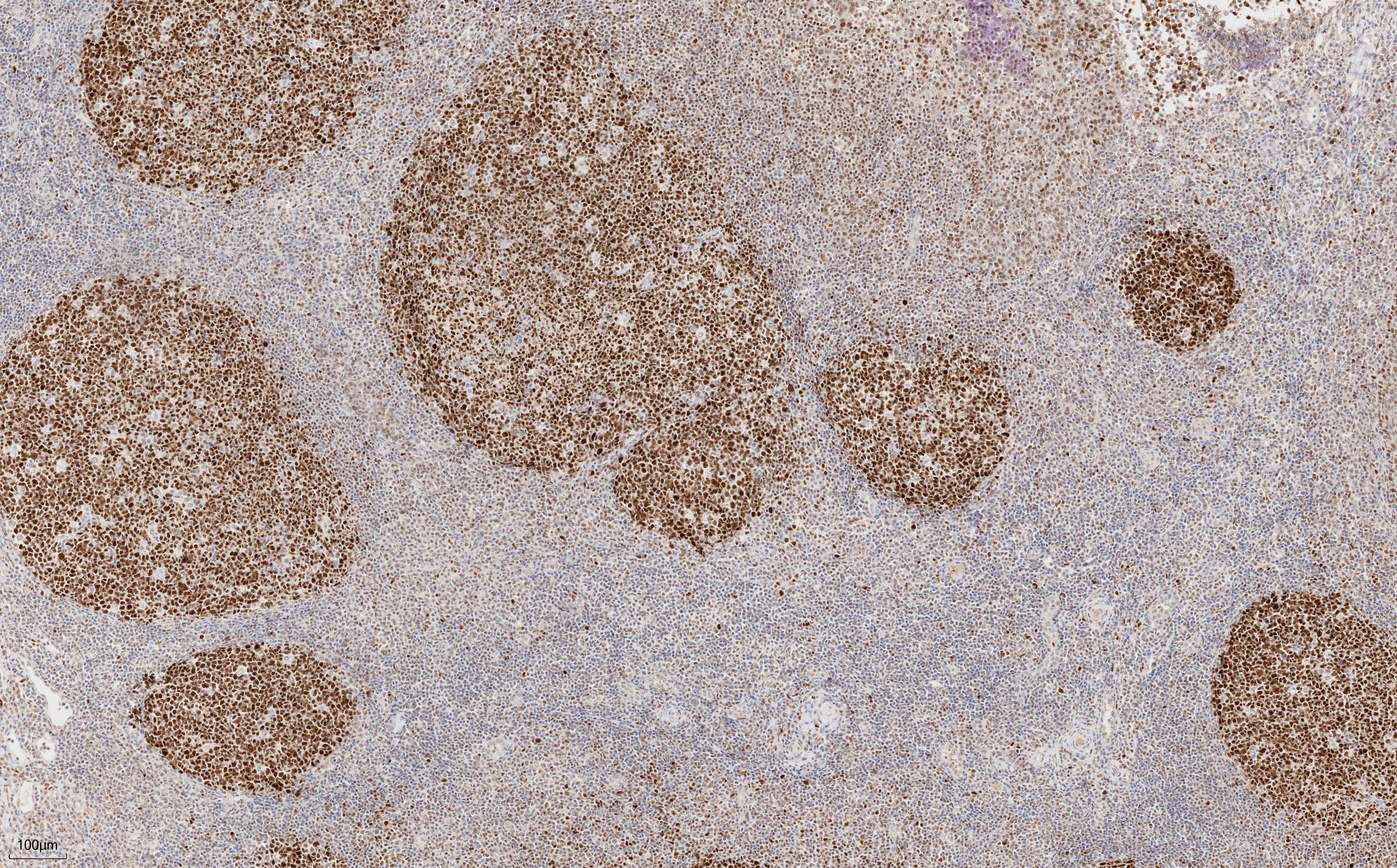 IHC staining of human tonsillitis using 66340-1-Ig (same clone as 66340-1-PBS)
