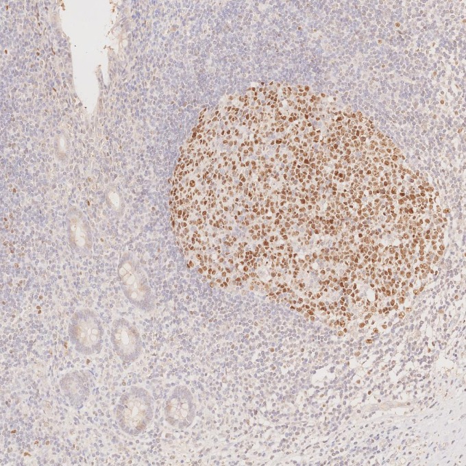 IHC staining of human appendicitis using 66340-1-Ig