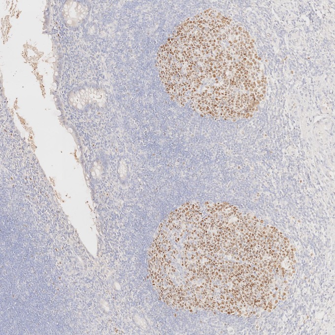 IHC staining of human appendicitis using 66340-1-Ig