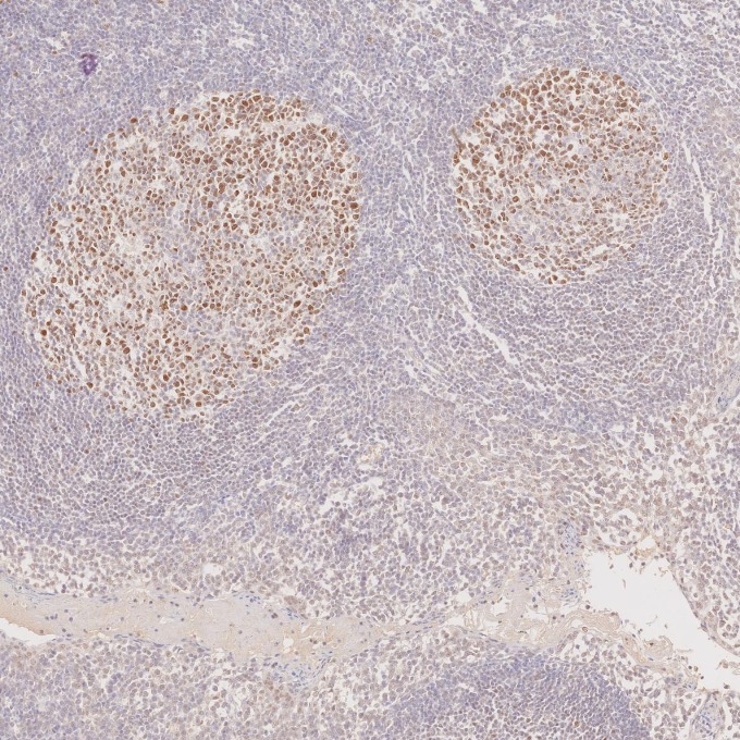 IHC staining of human tonsillitis using 66340-1-Ig