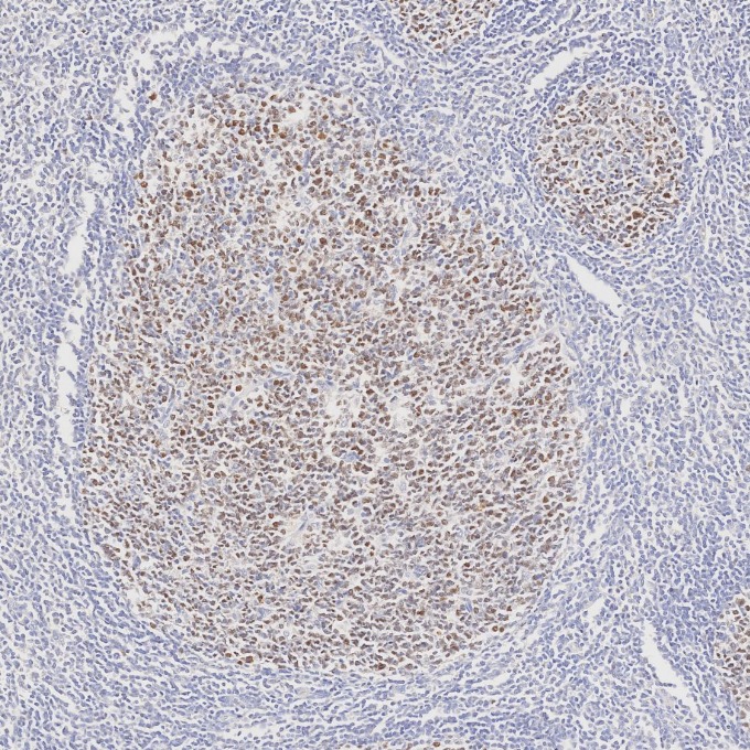 IHC staining of human tonsillitis using 66340-1-Ig