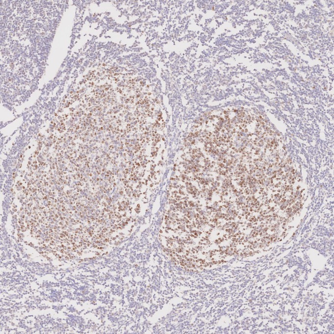 IHC staining of human tonsillitis using 66340-1-Ig