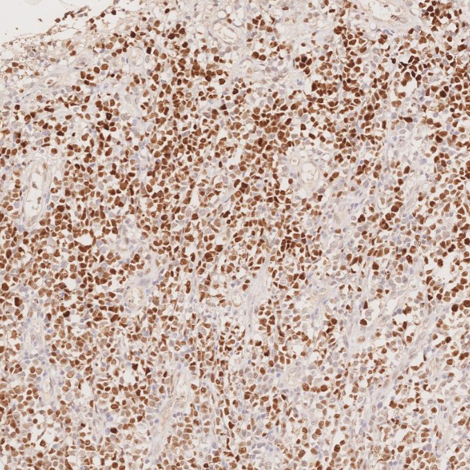 IHC staining of human lymphoma using 66340-1-Ig