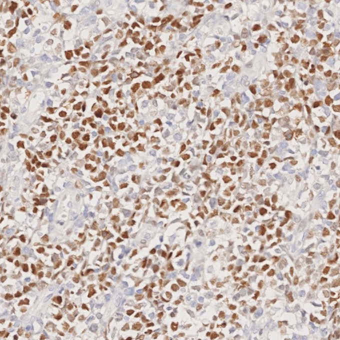 IHC staining of human lymphoma using 66340-1-Ig
