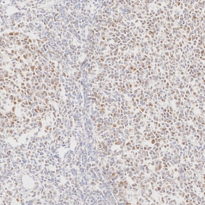 IHC staining of human lymphoma using 66340-1-Ig