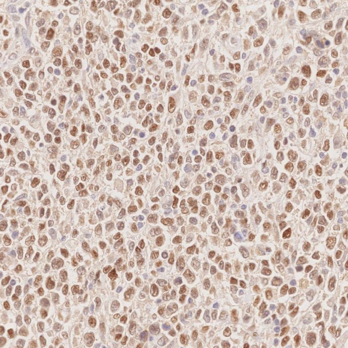 IHC staining of human lymphoma using 66340-1-Ig