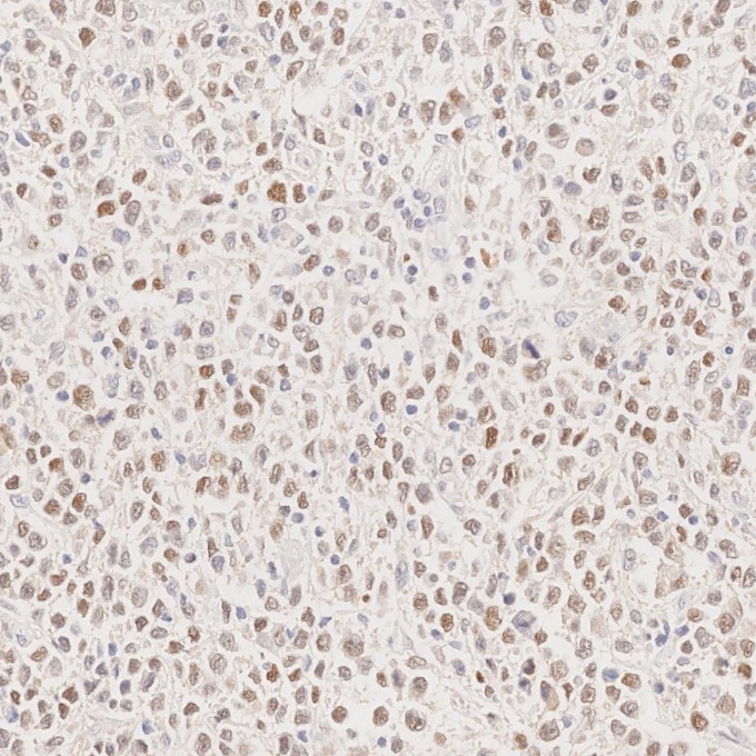 IHC staining of human lymphoma using 66340-1-Ig