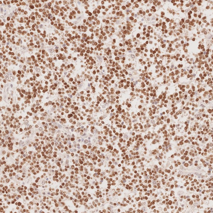 IHC staining of human lymphoma using 66340-1-Ig