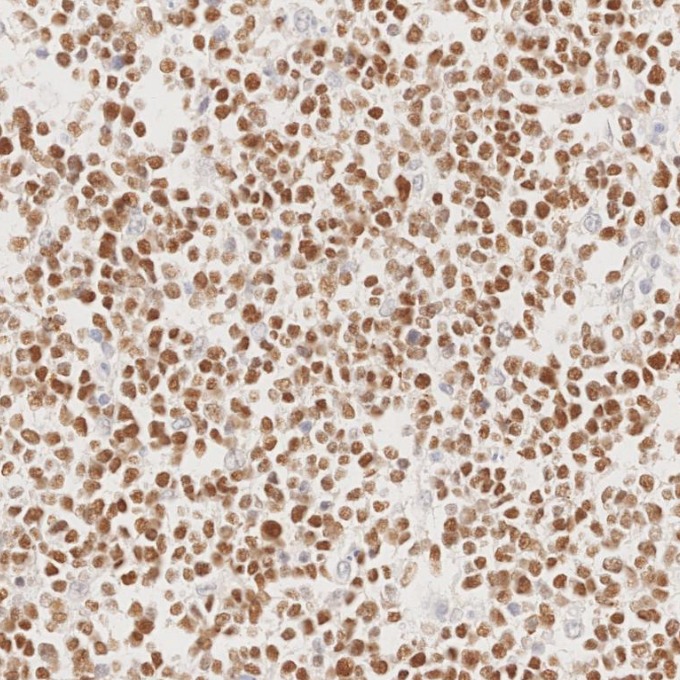 IHC staining of human lymphoma using 66340-1-Ig
