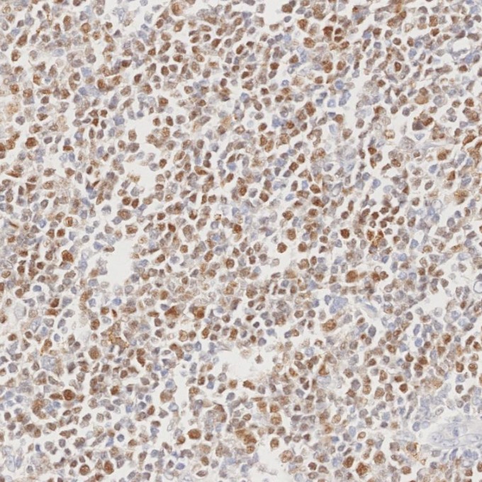 IHC staining of human lymphoma using 66340-1-Ig