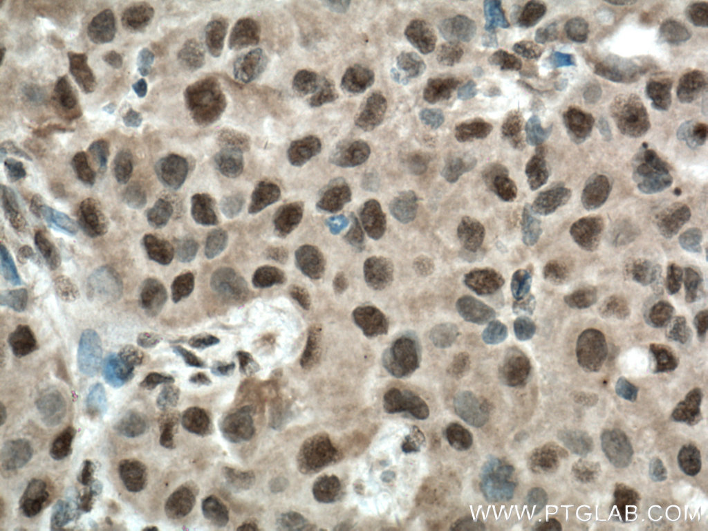 IHC staining of human breast cancer using 12107-1-AP