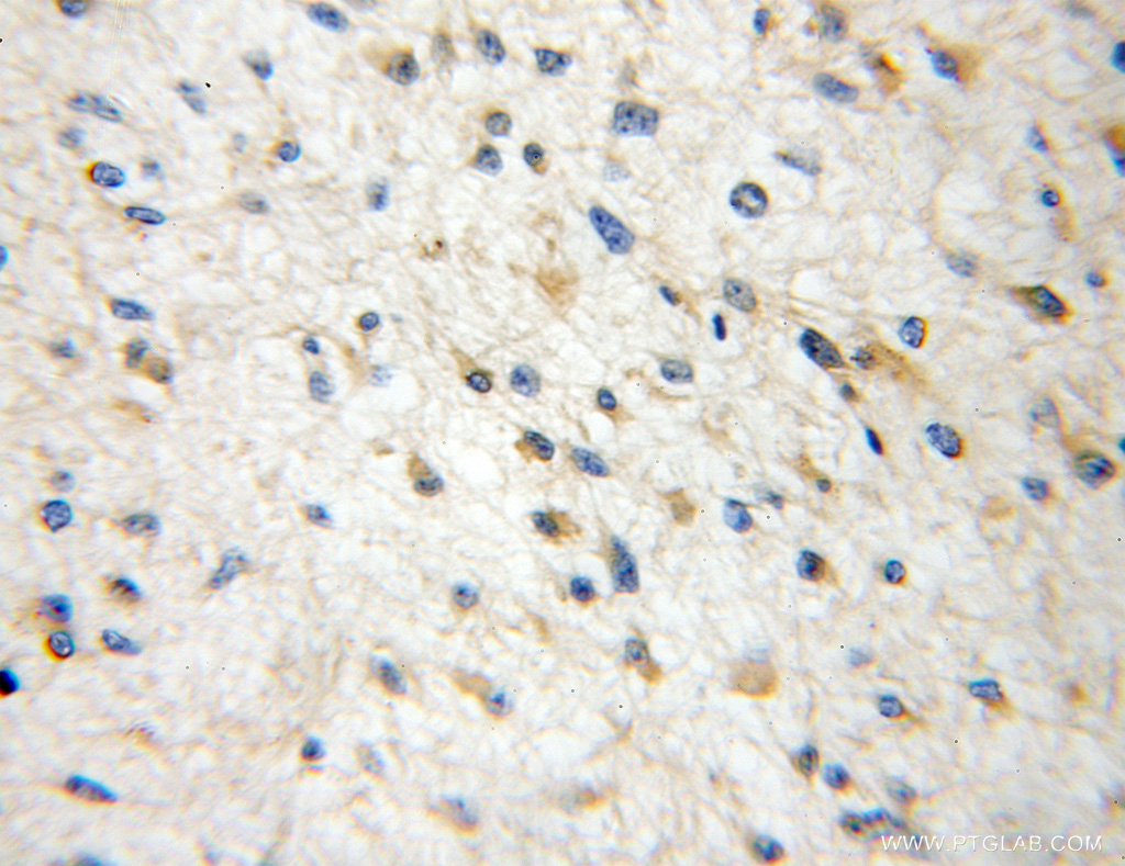 IHC staining of human gliomas using 10175-2-AP