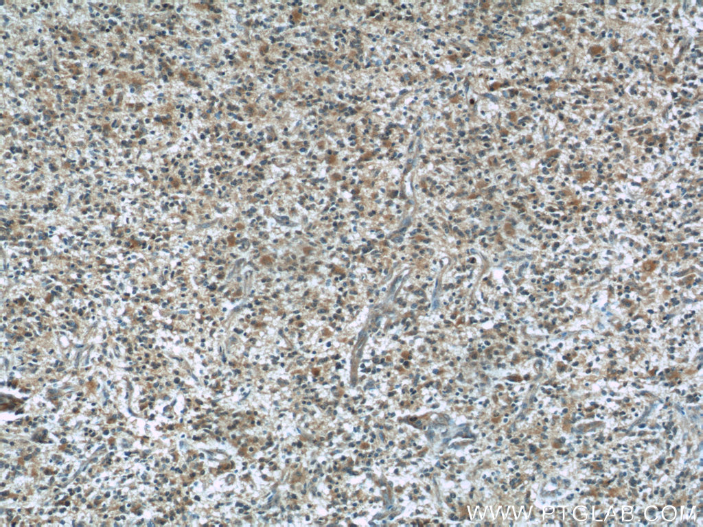 IHC staining of human gliomas using 60212-1-Ig
