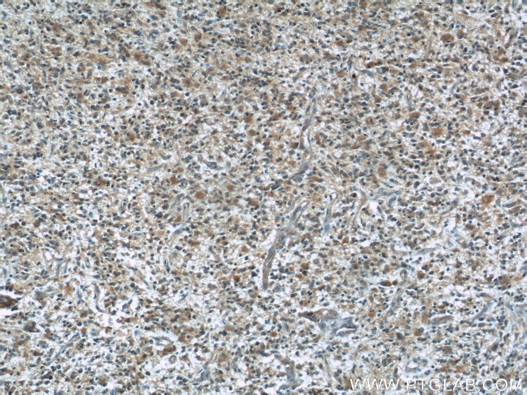 IHC staining of human gliomas using 60212-1-Ig (same clone as 60212-1-PBS)